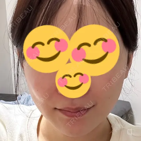 脂肪溶解注射（顔） あいち栄クリニック AFTER
