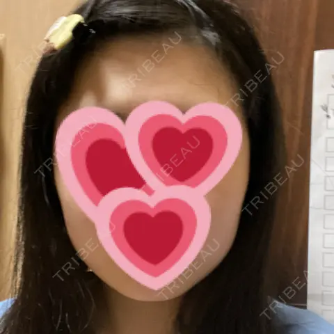 ボトックス（エラ・小顔） 湘南美容クリニック 本厚木院 AFTER
