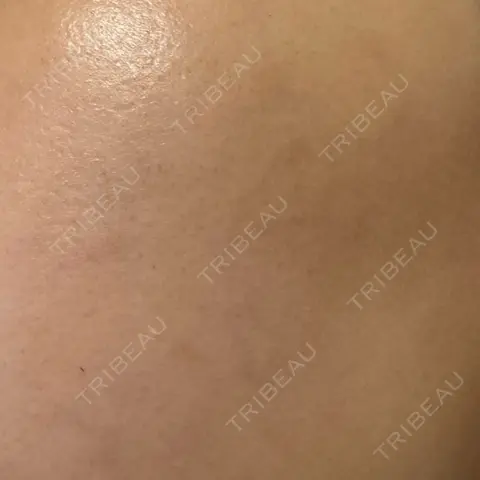 ルメッカ 東京美容外科 梅田院 AFTER