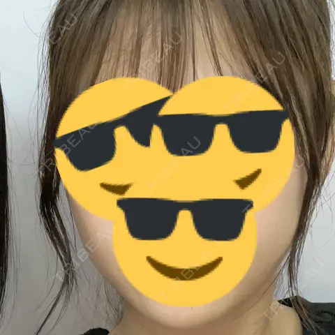 ボトックス（エラ・小顔） / 白玉点滴・注射 / ボトックス（首） おおたかの森ビューティークリニック AFTER