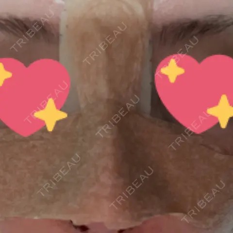 鼻尖形成（切開） / 軟骨移植 / 骨切幅寄せ / プロテーゼ除去 9BeautyClinic DAY 0