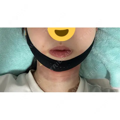 糸リフト / バッカルファット除去 / 脂肪吸引（顔） 湘南美容クリニック 銀座院 DAY 0
