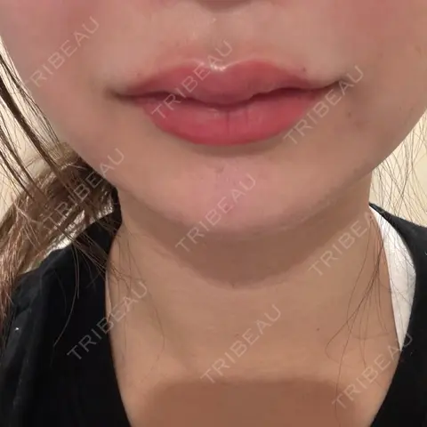 ヒアルロン酸注入（唇） / ボトックス（口角） ルラ美容クリニック 大阪本院 DAY 0