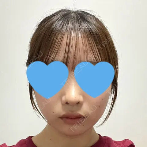 糸リフト / 脂肪吸引（顔） / 脂肪吸引注射（顔） SEA CLINIC（シークリニック） AFTER