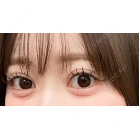二重埋没 / 自然癒着法 / ヒアルロン酸溶解 AI Beauty Clinic （エーアイ美容クリニック） AFTER