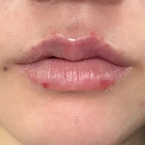 ヒアルロン酸注入（唇） / ボトックス（口角） R Beauty CLINIC 銀座院 AFTER