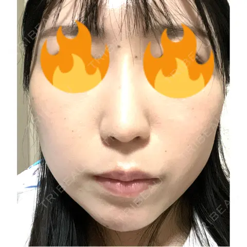 軟骨移植 / 鼻尖形成（非切開） / 鼻柱下降・鼻唇角形成（猫手術） / ヒアルロン酸注入（あご） / その他（鼻） グローバルビューティークリニック 東京院 AFTER