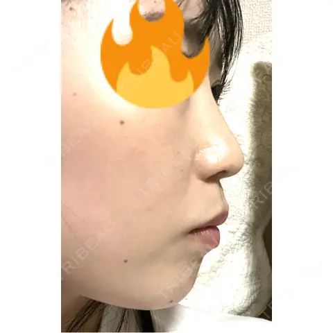 軟骨移植 / 鼻尖形成（非切開） / 鼻柱下降・鼻唇角形成（猫手術） / ヒアルロン酸注入（あご） / その他（鼻） グローバルビューティークリニック 東京院 AFTER