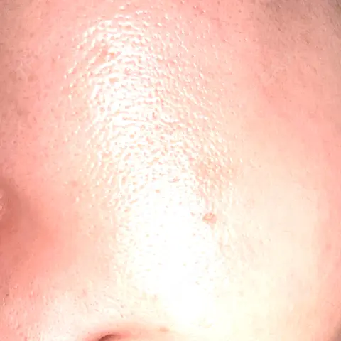 白玉点滴・注射 新宿美容内科医療クリニック AFTER