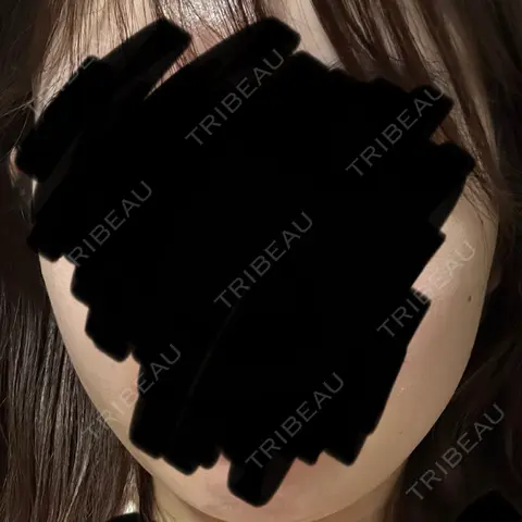 ハイフ（顔） 東京美容外科 名古屋院 AFTER