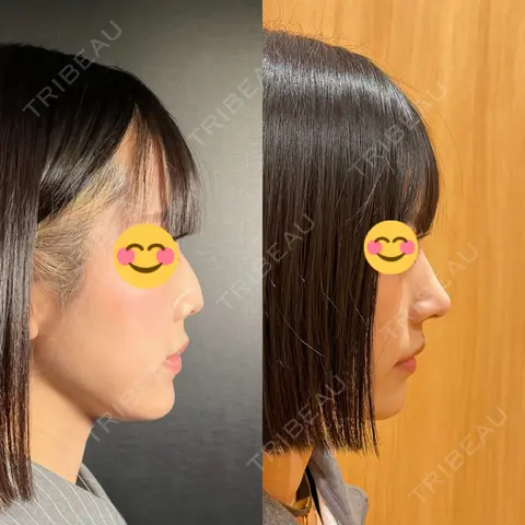 鼻尖形成（切開） / 鼻中隔延長（切開） / 軟骨移植 / ワシ鼻修正・ハンプ切除 / 鼻修正 R Beauty CLINIC 銀座院 AFTER