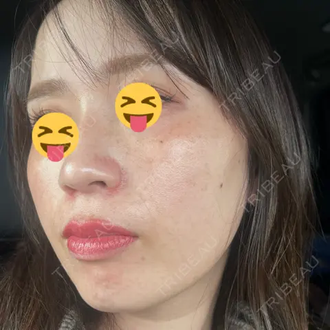 シミ取りレーザー / ピコレーザートーニング（美白・肝斑） PRISM Beauty Clinic AFTER