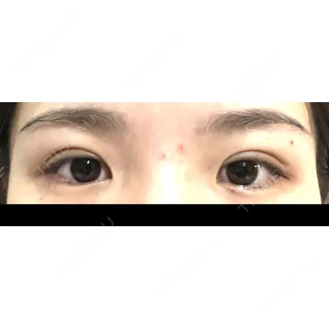 二重埋没 AI Beauty Clinic （エーアイ美容クリニック） DAY 0