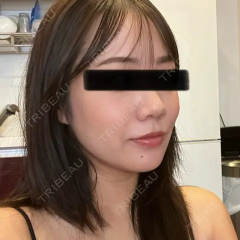 脂肪吸引（顔） / ジョールファット除去 / 脂肪注入（輪郭） 湘南美容クリニック 吉祥寺院 AFTER