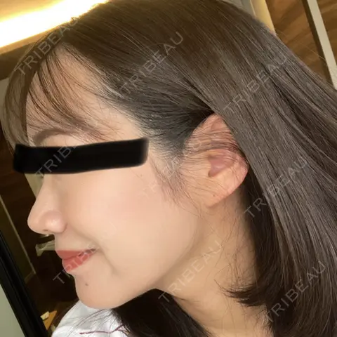 脂肪吸引（顔） / ジョールファット除去 / 脂肪注入（輪郭） 湘南美容クリニック 吉祥寺院 AFTER