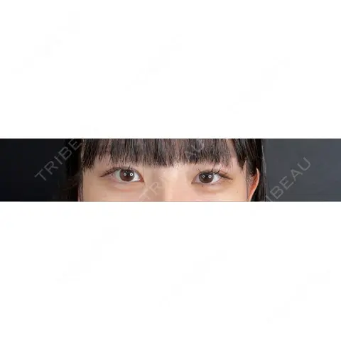 二重埋没 / クマ治療 / 上まぶたの脂肪取り / 脂肪注入（目の下） 藤・ナチュレ美容クリニック 銀座院 AFTER