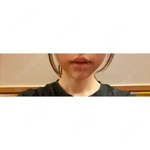 ボトックス（あご） / ヒアルロン酸注入（あご） 銀座みゆき通り美容外科 大阪梅田院 AFTER