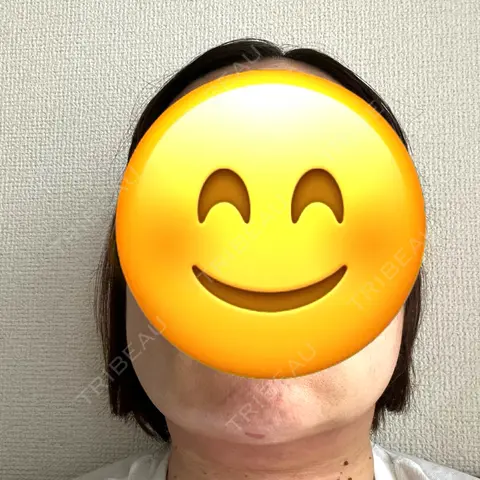 糸リフト / 脂肪吸引（顔） / ジョールファット除去 / ボトックス（エラ・小顔） アリエル美容クリニック 大宮院 DAY 1