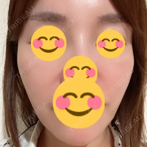 脂肪注入（輪郭） / マイクロボトックス / ボトックス（ガミースマイル） / PRP皮膚再生療法 EMMO FACE CLINIC 大宮院 AFTER