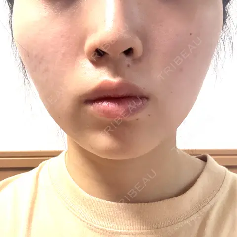 ボトックス（エラ・小顔） TCB東京中央美容外科 中野院 AFTER