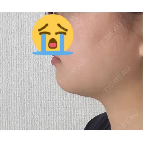 脂肪吸引注射（顔） MIL CLINIC OSAKA AFTER
