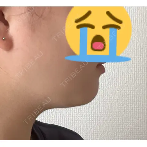 脂肪吸引注射（顔） MIL CLINIC OSAKA AFTER