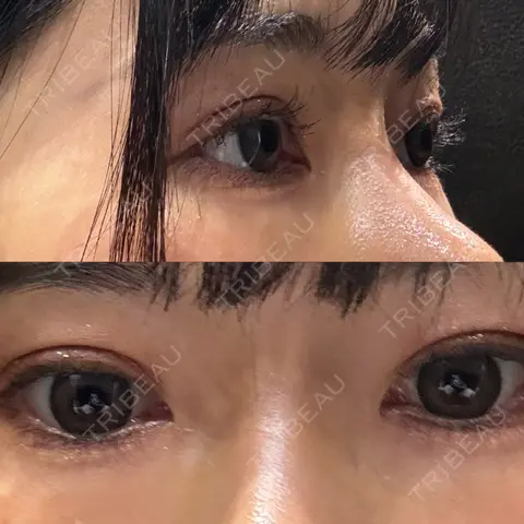 二重切開 / 鼻尖形成（切開） / 鼻中隔延長（切開） / 小鼻縮小（切開） / 軟骨移植 / ワシ鼻修正・ハンプ切除 / 鼻尖縮小 / 切開リフト LUHO（ルホ）美容外科 DAY 30