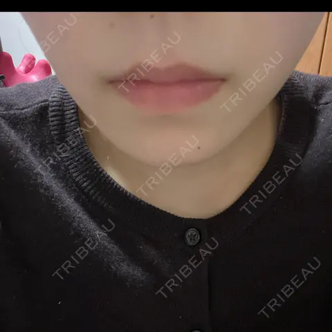 ボトックス（エラ・小顔） CLINIC W DAY 0