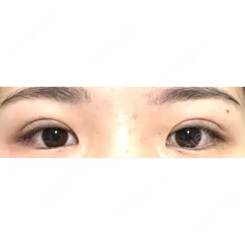 二重埋没 AI Beauty Clinic （エーアイ美容クリニック） AFTER