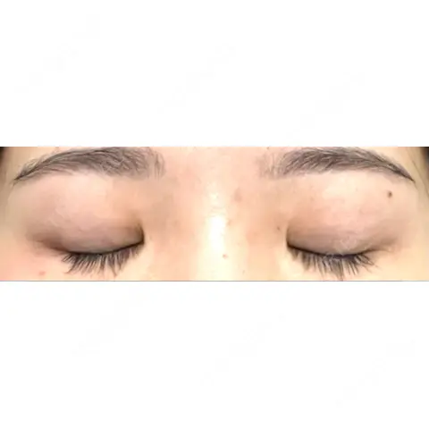 二重埋没 AI Beauty Clinic （エーアイ美容クリニック） AFTER