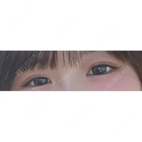 二重埋没 シンデレラ＆ダヴィンチクリニック AFTER