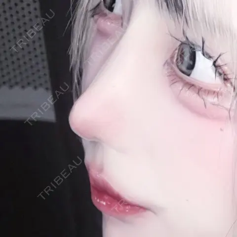 隆鼻術 / 鼻尖形成（切開） / 鼻中隔延長（切開） / 軟骨移植 R Beauty CLINIC 大阪院 DAY 44
