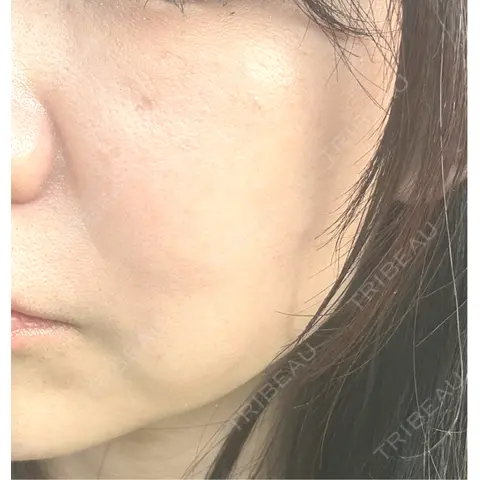 光治療（フォトフェイシャルなど） 大美会クリニック 岡山院 AFTER