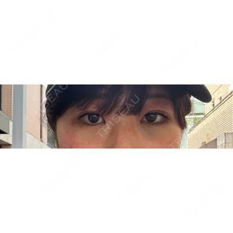 クマ治療 / 下まぶたたるみ取り / 下まぶたの脂肪取り APOLLO BEAUTY CLINIC DAY 0