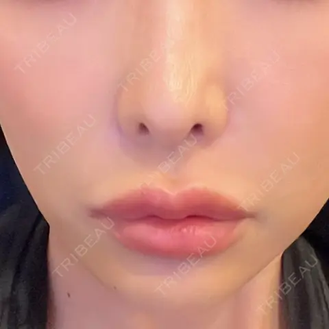 ヒアルロン酸注入（あご） L‘amour clinic Tokyo【ラムールクリニック東京】 DAY 0