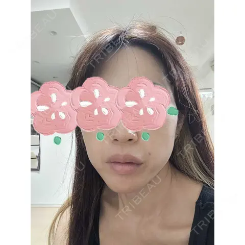糸リフト / 肌ヒアルロン酸注入（たるみ・シワ改善） ルラ美容クリニック 大宮院 DAY 0