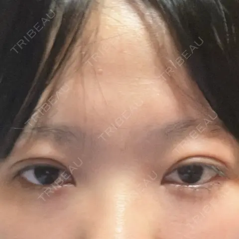 二重埋没 WOM CLINIC GINZA （ワム クリニック ギンザ） DAY 0