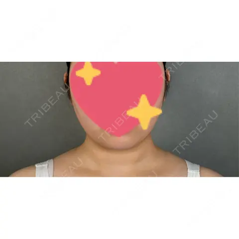 糸リフト / バッカルファット除去 / 脂肪吸引（顔） / ボトックス（エラ・小顔） アリエル美容クリニック 大宮院 DAY 0