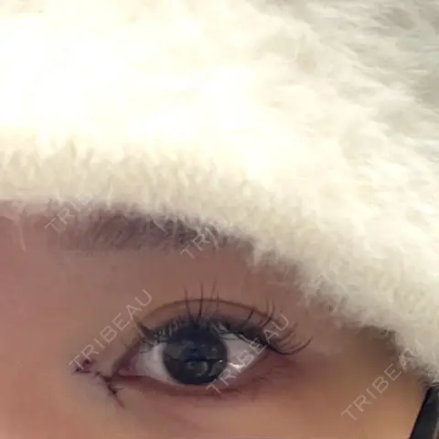 目頭切開 9BeautyClinic DAY 0