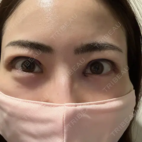 二重切開 / 目頭切開 / 眼瞼下垂（切開） / 上まぶたの脂肪取り WOM CLINIC GINZA （ワム クリニック ギンザ） DAY 0