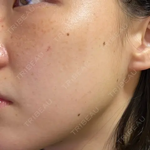 ピーリング（ニキビ・毛穴） / 光治療（フォトフェイシャルなど） オーキッド美容クリニック東京御徒町 AFTER