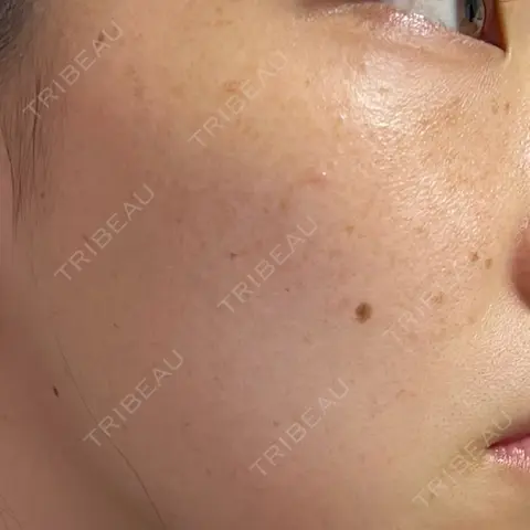 ピーリング（ニキビ・毛穴） / 光治療（フォトフェイシャルなど） オーキッド美容クリニック東京御徒町 AFTER