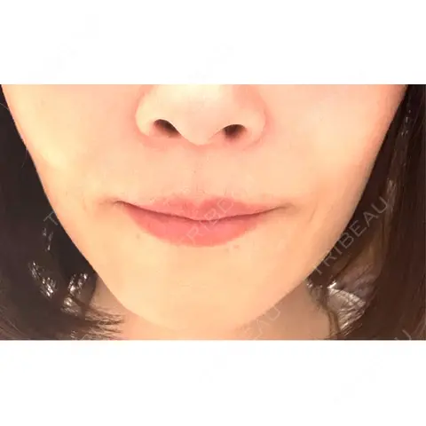 ヒアルロン酸注入（頬） 湘南美容クリニック 銀座院 DAY 0