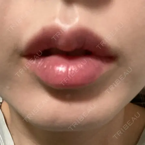 ヒアルロン酸注入（唇） L‘amour clinic Tokyo【ラムールクリニック東京】 DAY 0