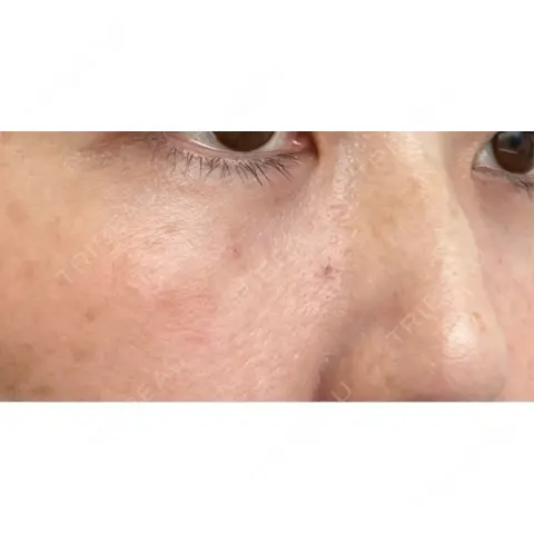 クマ治療 / 下まぶたの脂肪取り ROOTS Clinic AFTER