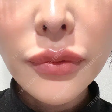 ヒアルロン酸注入（あご） L‘amour clinic Tokyo【ラムールクリニック東京】 AFTER
