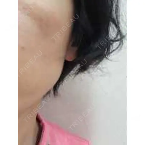 光治療（フォトフェイシャルなど） 日比谷セントラルクリニック AFTER