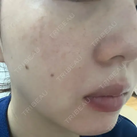 ルメッカ GLAMRULE CLINIC (グラムルール クリニック) 銀座院 AFTER