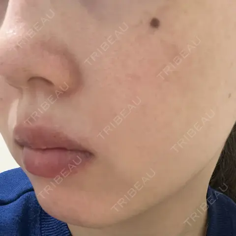 ルメッカ GLAMRULE CLINIC (グラムルール クリニック) 銀座院 AFTER