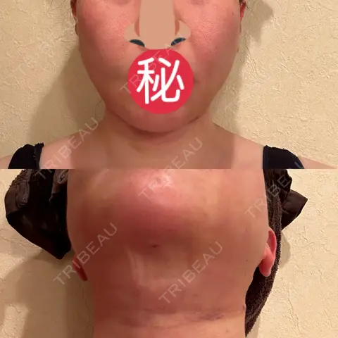 糸リフト / 脂肪吸引（顔） / ジョールファット除去 / 脂肪吸引注射（顔） SEA CLINIC（シークリニック） DAY 1